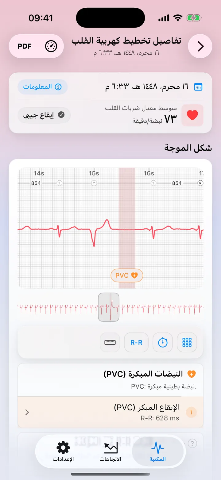 عرض تفصيلي في ECG Tracker+ يوضح إشارة إلى نمط PVC محتمل على الموجة