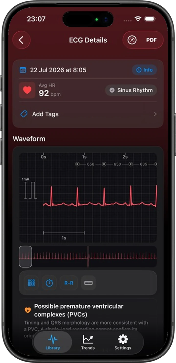 An iPhone frame showing the current ECG Tracker+ example of a possible premature ventricular beat pattern