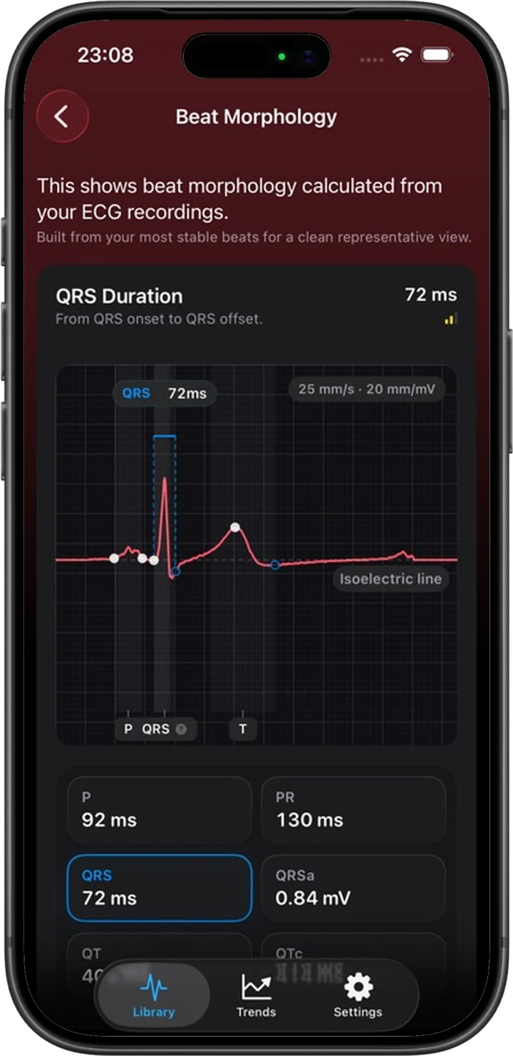 An iPhone frame showing the ECG Tracker+ beat morphology view with QRS onset and offset markers