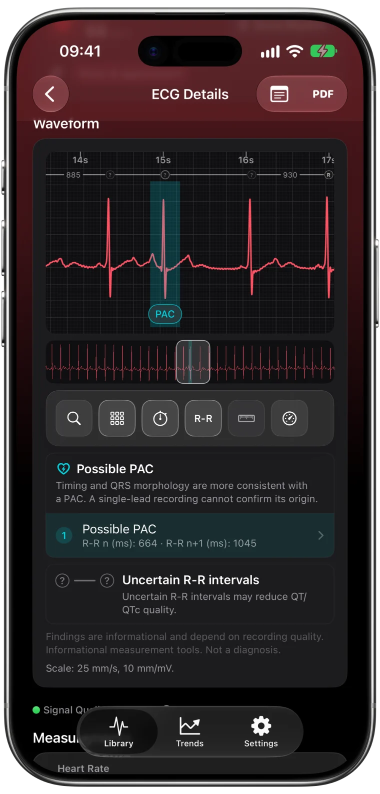 ECG Tracker+ waveform with a beat marked as a possible PAC, R-R intervals of 664 ms before and 1,045 ms after