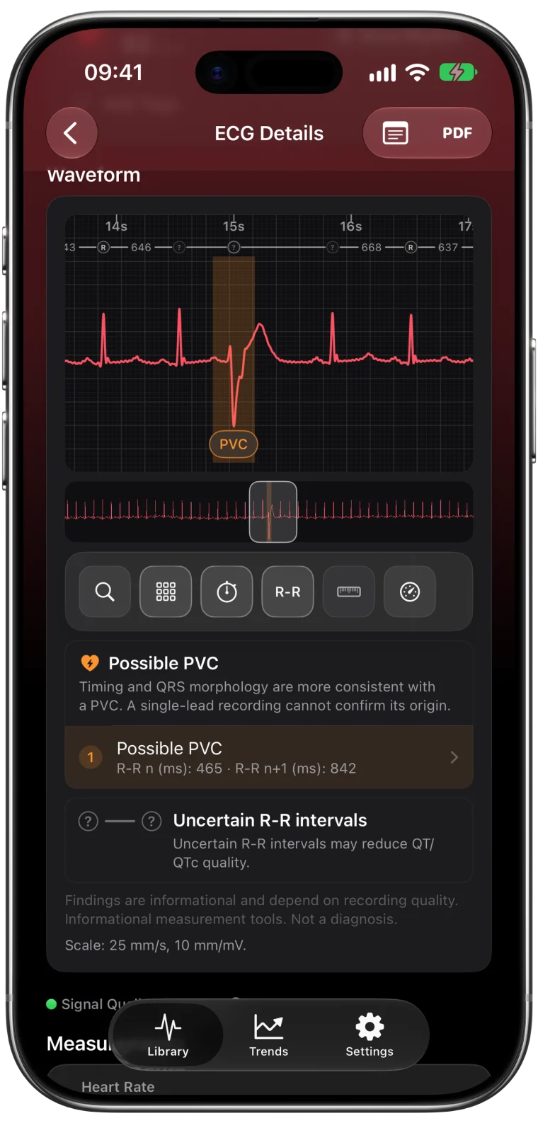 ECG Tracker+ waveform highlighting a possible PVC, with adjacent RR intervals of 465 and 842 ms and the full single-lead limitation.