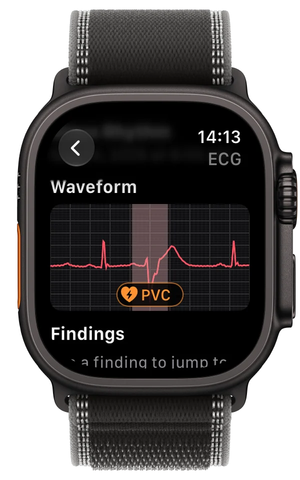 An ECG recording on Apple Watch Ultra with a possible PVC marked on the waveform