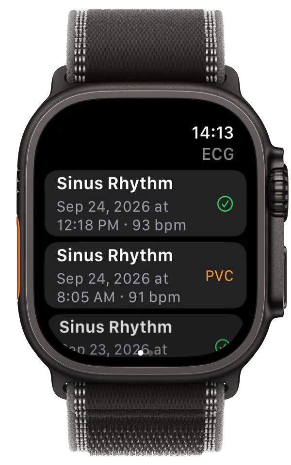 ECG Tracker+ on Apple Watch Ultra listing ECG recordings, with a possible PVC flagged on one of them