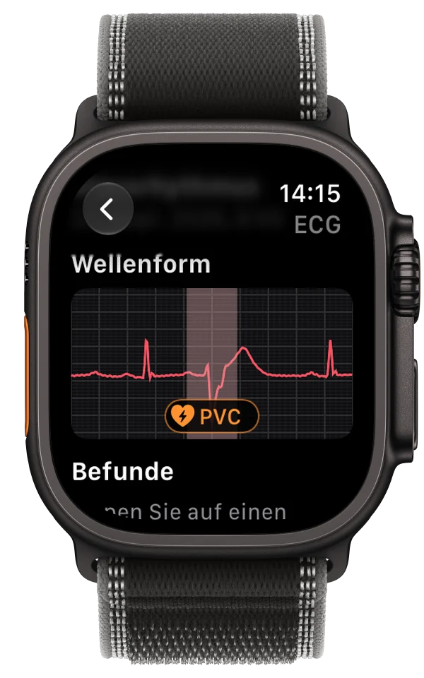 Eine EKG-Aufzeichnung auf der Apple Watch Ultra mit einem möglichen PVC, der auf der Kurve markiert ist