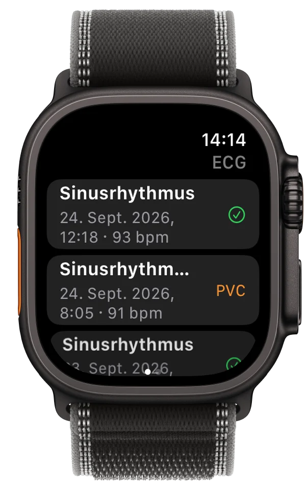 ECG Tracker+ auf der Apple Watch Ultra mit einer Liste von EKG-Aufzeichnungen, bei einer davon ist ein möglicher PVC markiert