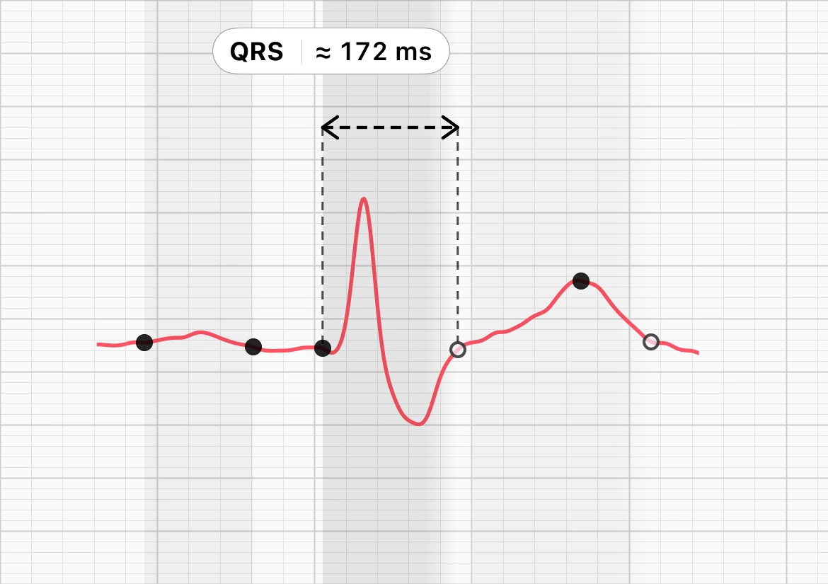 Ein Herzschlag in der Schlagmorphologie von ECG Tracker+, der QRS von Beginn bis Ende mit einer Klammer markiert und mit QRS etwa 172 ms beschriftet