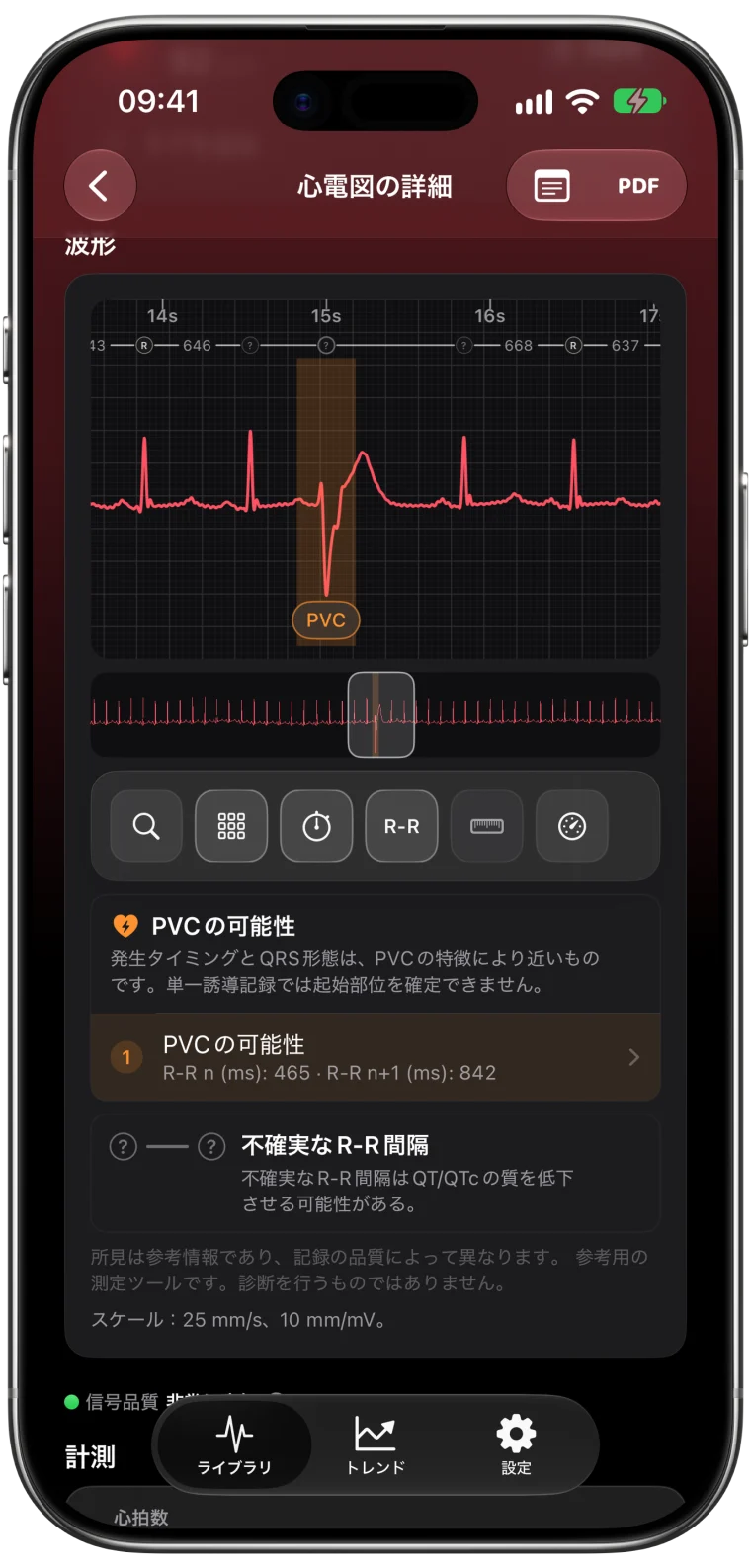 PVCの可能性がある拍動を強調表示したECG Tracker+の波形。前後のRR間隔465 msと842 ms、単一誘導の限界についての注記全文を表示。