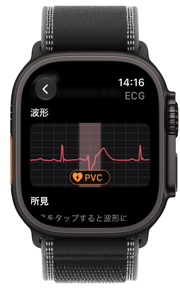 PVCの可能性がある拍動を波形上にマークした、Apple Watch Ultraの心電図記録