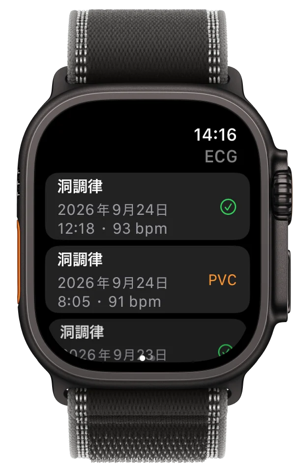 心電図記録の一覧を表示したApple Watch Ultra上のECG Tracker+。うち1件にPVCの可能性を示すフラグ