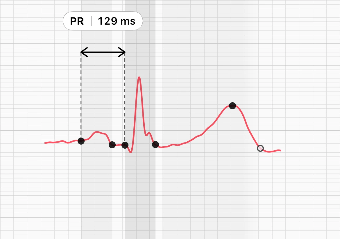 ECG Tracker+の「拍動形態」に表示された1拍。P波の始まりからQRS波の始まりまでに括弧が付き、「PR 129 ms」と表示されている
