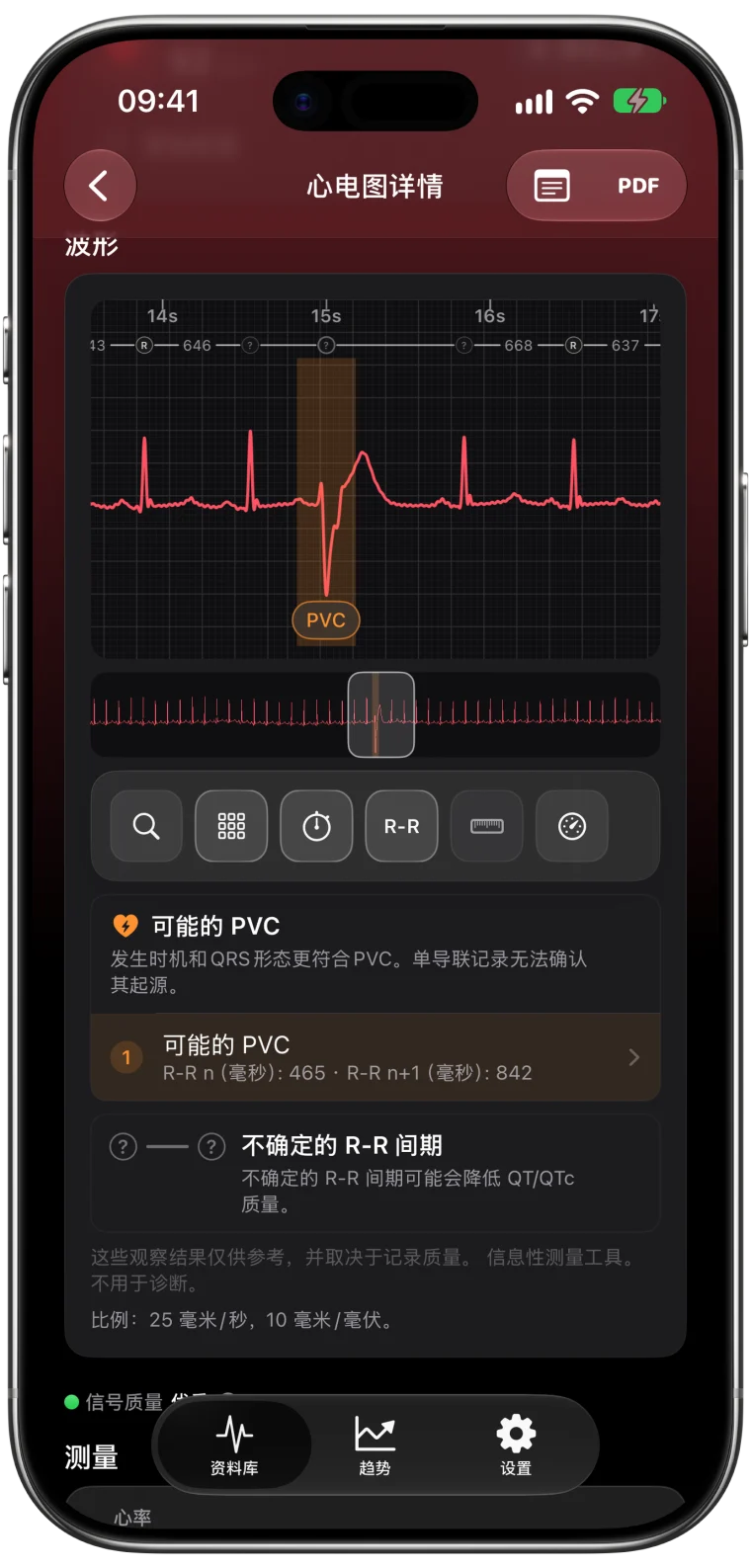 ECG Tracker+ 波形，突出显示一次可能的 PVC，相邻 RR 间期为 465 ms 和 842 ms，并附完整的单导联局限性说明。