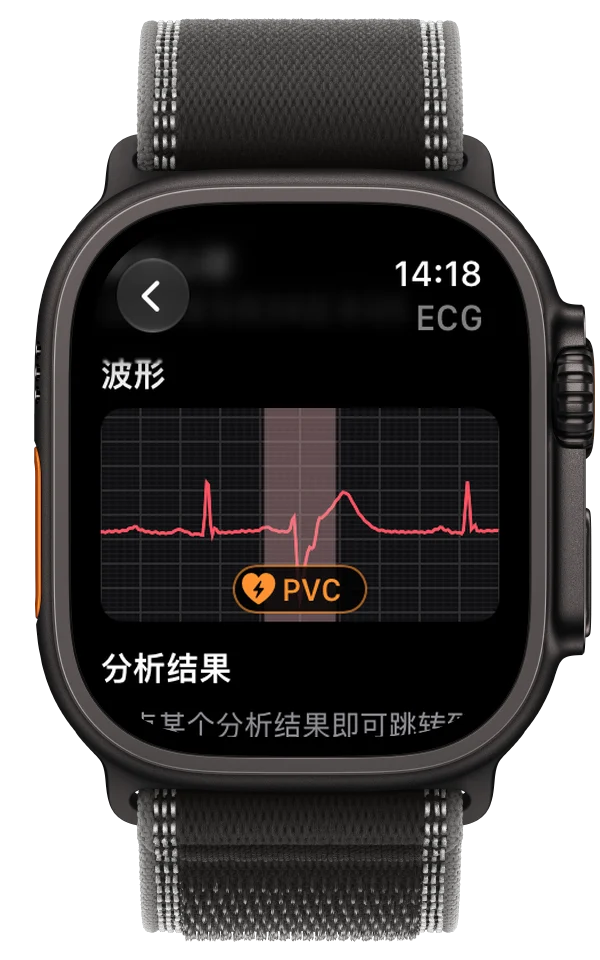 Apple Watch Ultra 上的一份心电图记录，波形上标出了一次可能的 PVC