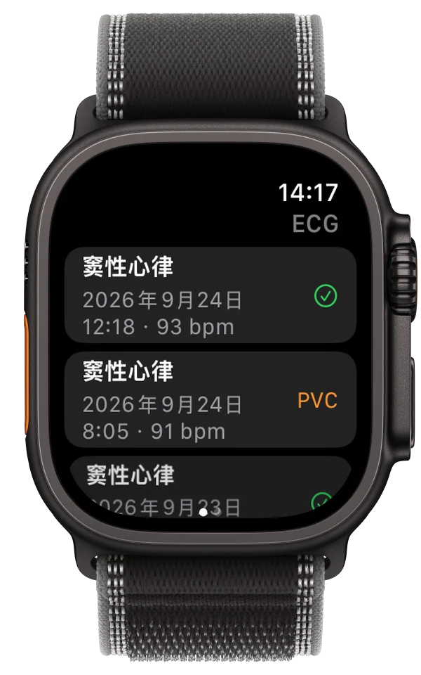 Apple Watch Ultra 上的 ECG Tracker+ 列出多份心电图记录，其中一份标出了可能的 PVC