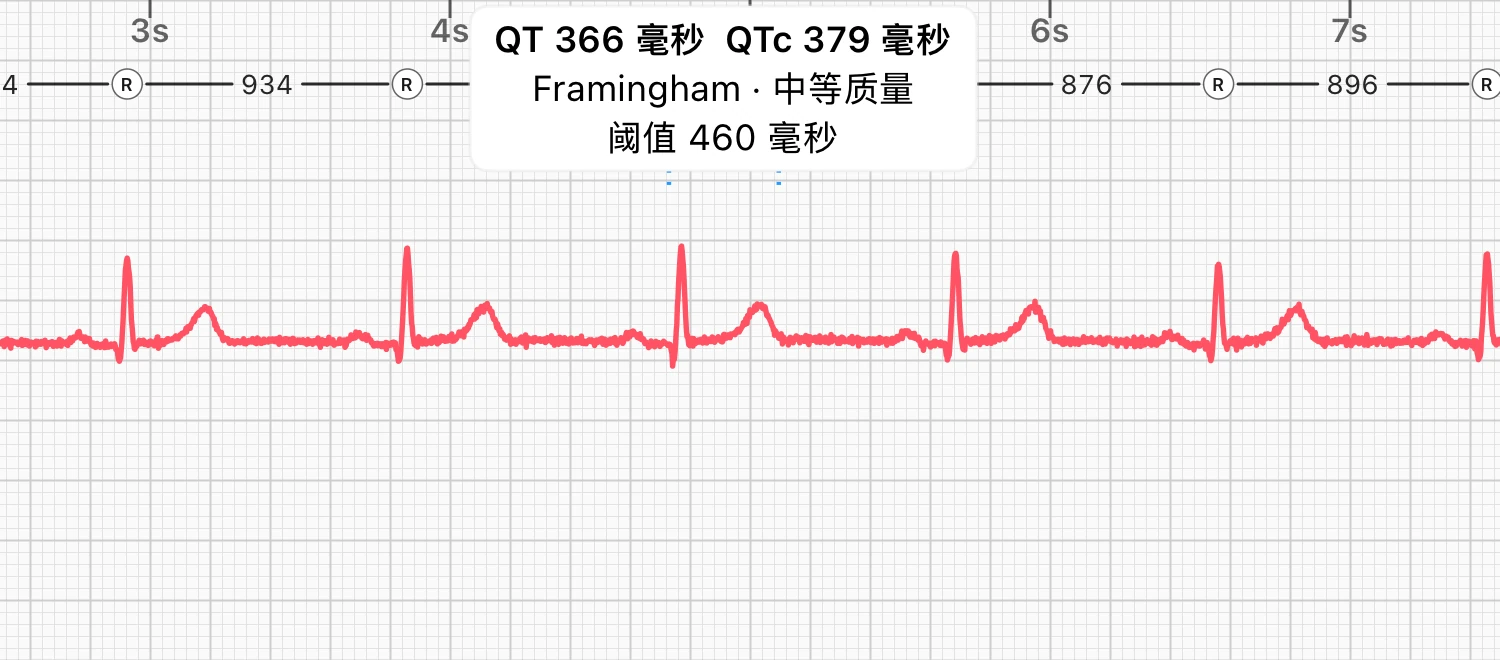 一段 10 秒的 I 导联静息心电图，其中一次心搏的 QT 间期用括号标出，ECG Tracker+ 标注为 QT 366 ms 和 QTc 379 ms