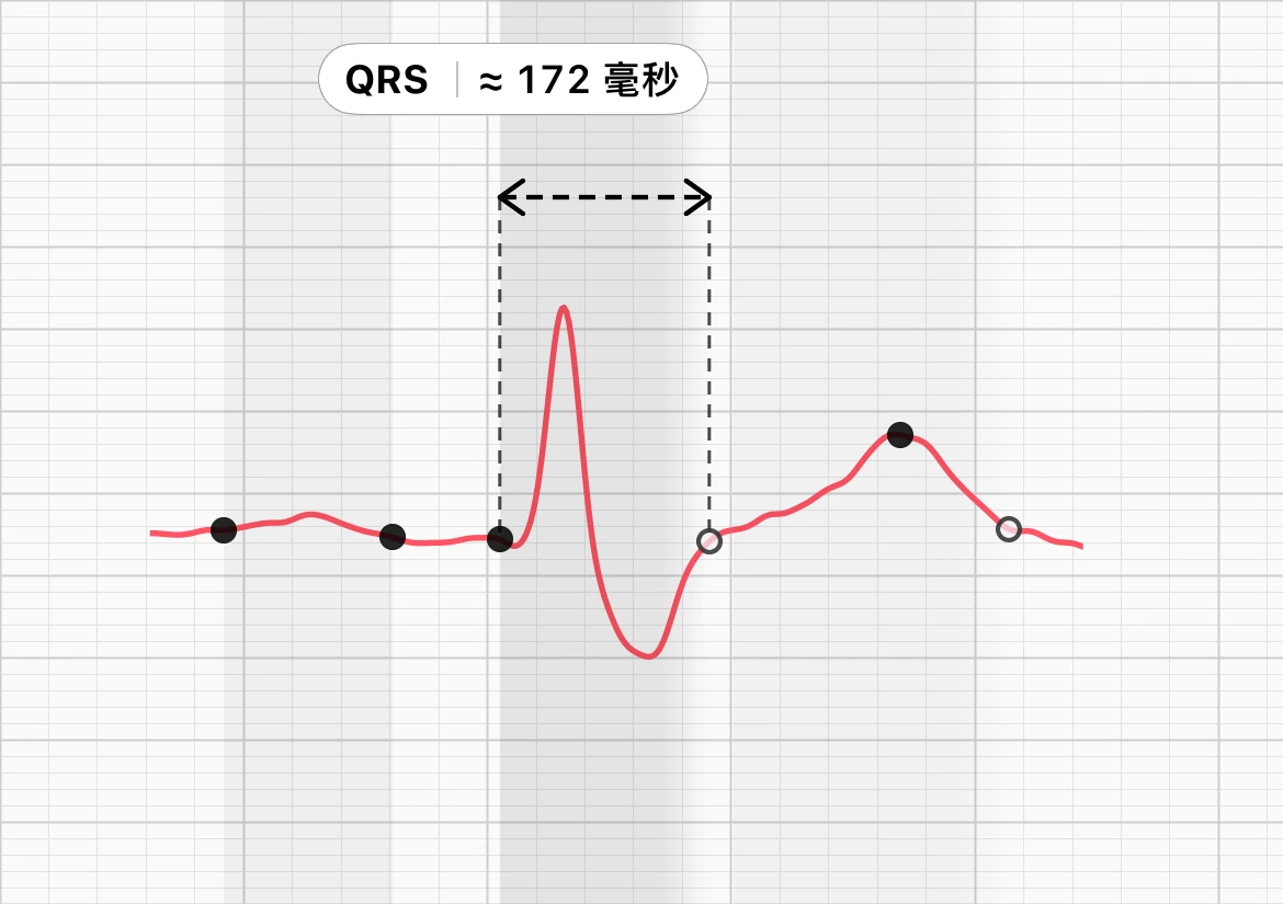 ECG Tracker+ 心搏形态视图中的一次心跳，QRS 从起点到终点用括号标出，标注为 QRS 约 172 ms