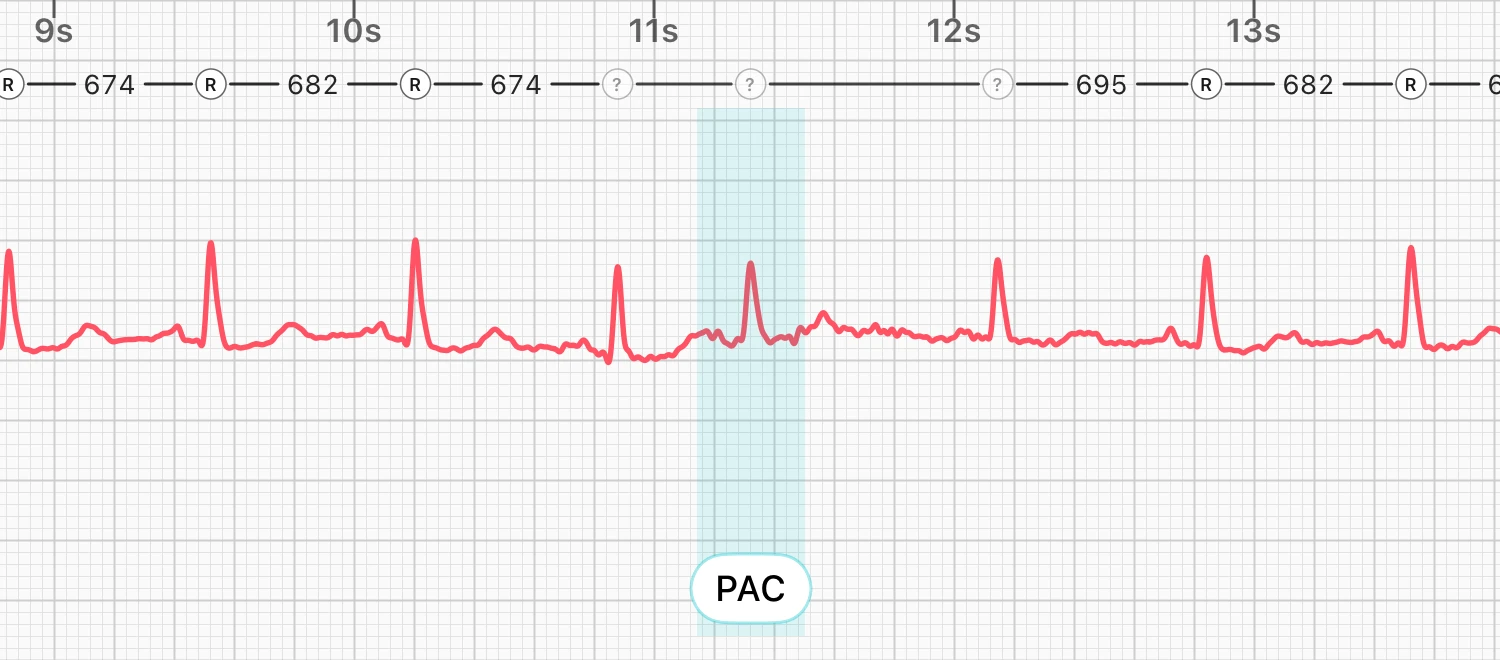 Five seconds of a lead I ECG with regular beats and one early beat highlighted as a possible PAC by ECG Tracker+, with the R-R intervals shown above the waveform