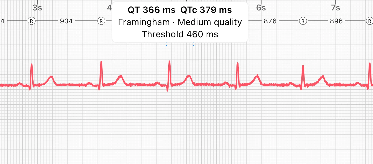 Ten seconds of a resting ECG in lead I, with the QT interval of one beat bracketed and labeled by ECG Tracker+ with QT 366 ms and QTc 379 ms