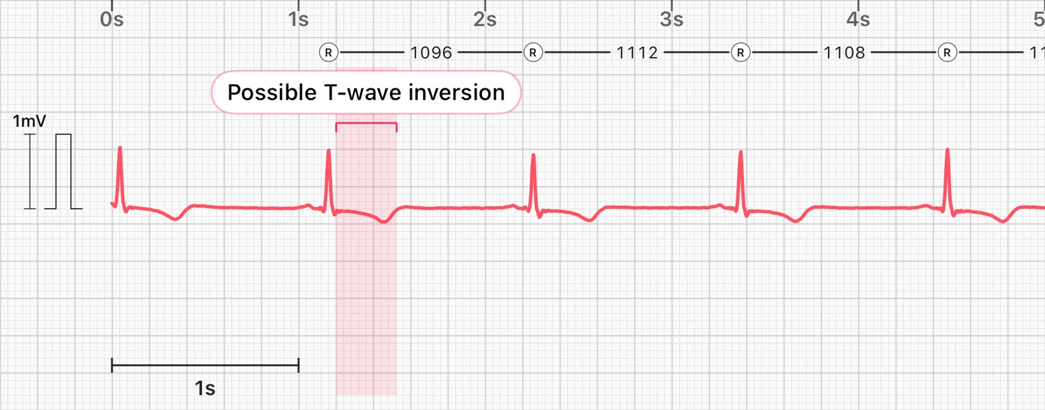 Five seconds of a lead I ECG with upright QRS spikes, each followed by a small downward T wave, with one beat highlighted and labeled possible T-wave inversion