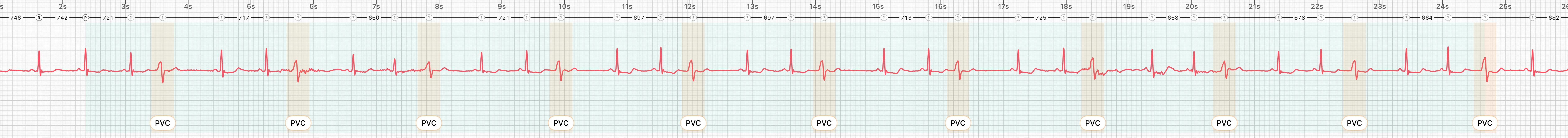 About 25 seconds of a lead I ECG in which every third beat is an early beat, with the stretch shaded and labeled possible trigeminy