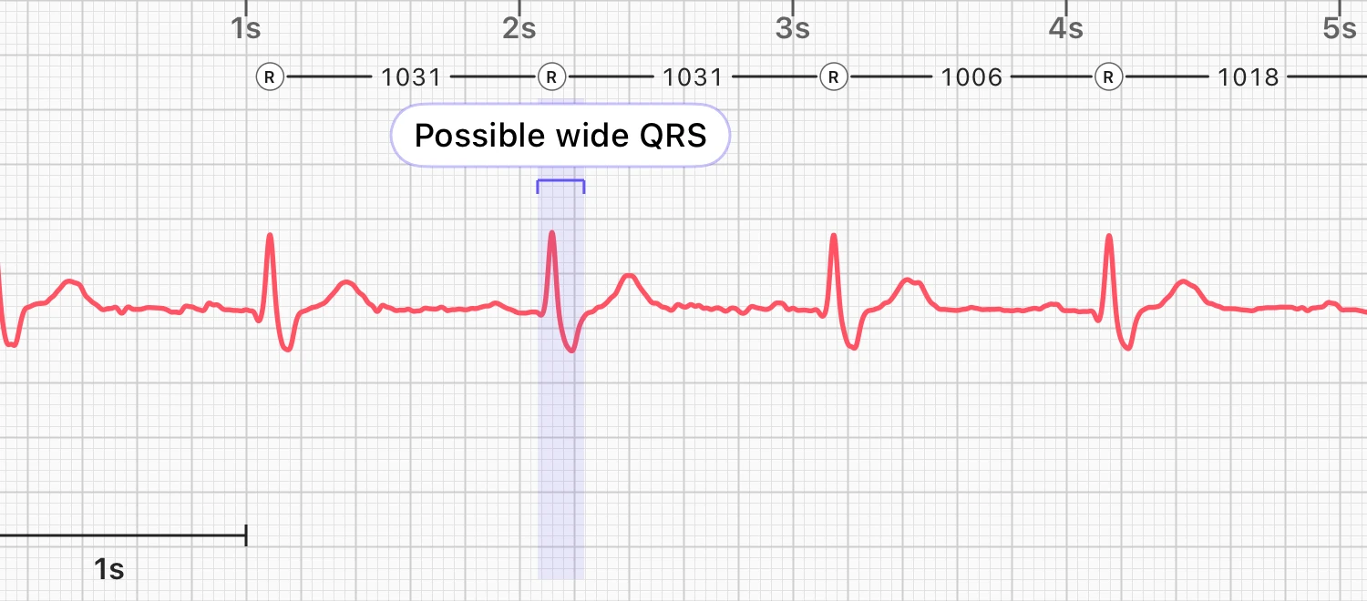 Five seconds of a lead I ECG with regular beats, each followed by a broad downward wave, with one beat highlighted and labeled possible wide QRS