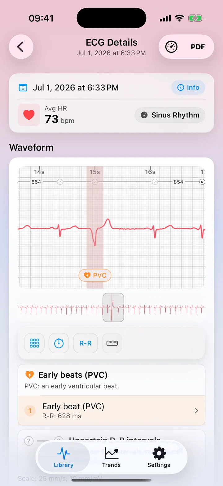 ECG Tracker+ detail view showing a possible PVC pattern flag on the waveform