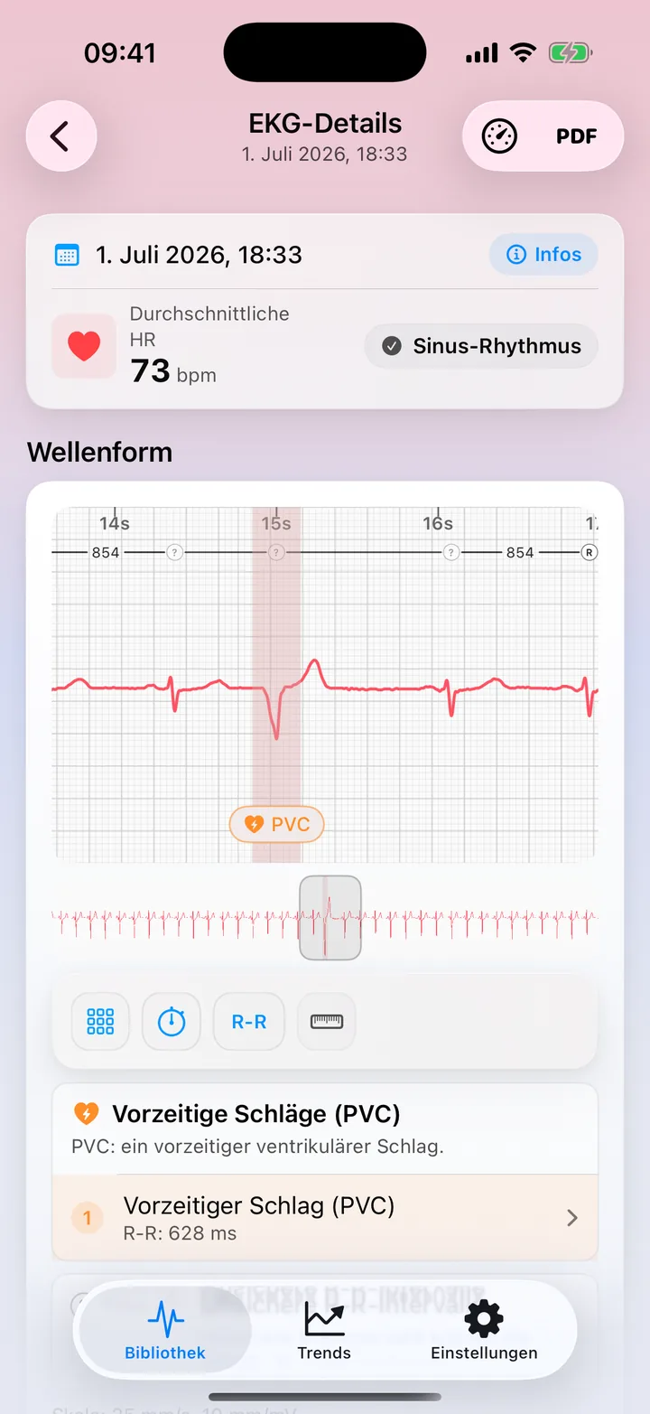 Detailansicht in ECG Tracker+ mit einem Hinweis auf ein mögliches PVC-Muster in der Kurve