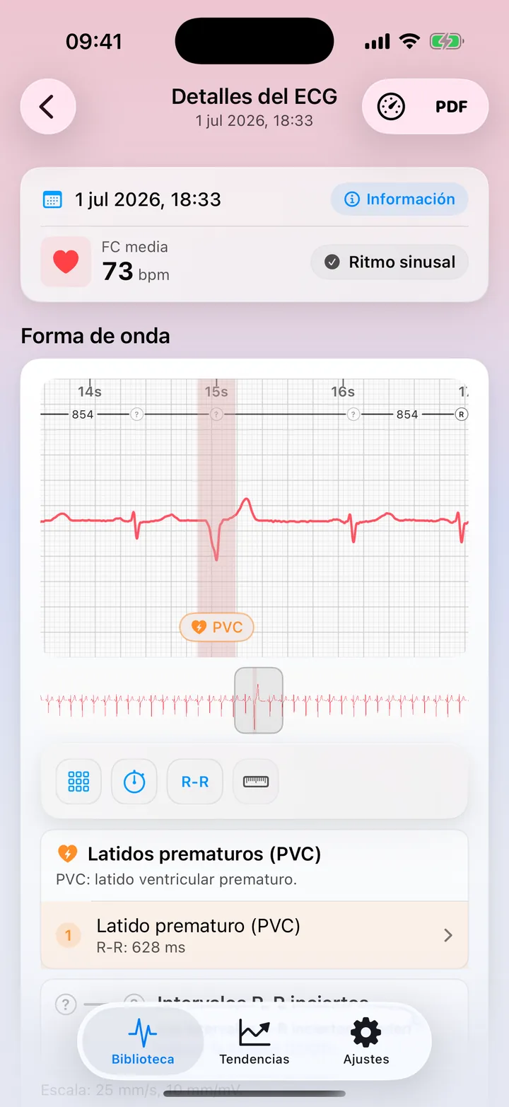 Vista detallada de ECG Tracker+ con un aviso de posible patrón de PVC sobre la onda