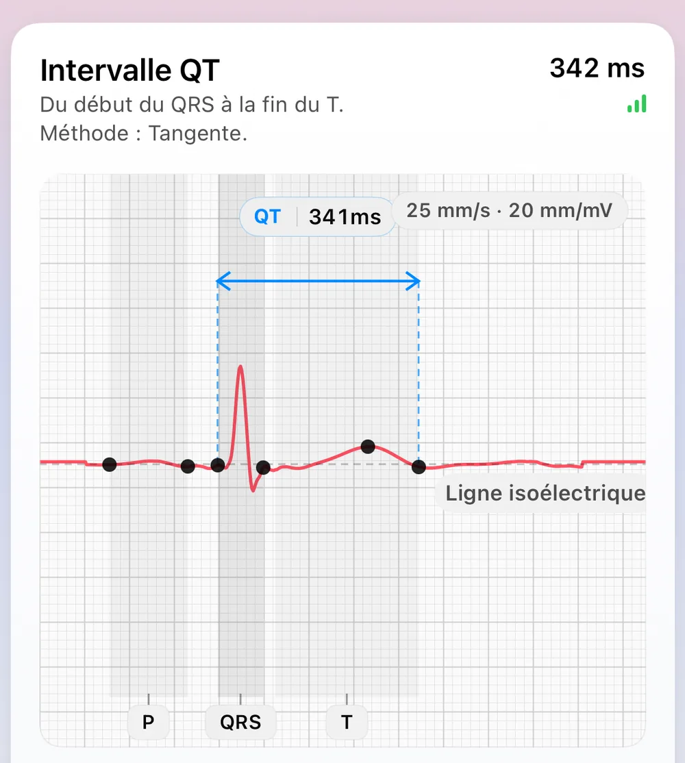 L'écran Morphologie des battements d'ECG Tracker+ : un battement représentatif construit à partir des battements les plus stables, avec les repères P, QRS et T, la ligne isoélectrique et un intervalle QT de 341 ms mesuré par la méthode de la tangente (du début du QRS à la fin de l'onde T)
