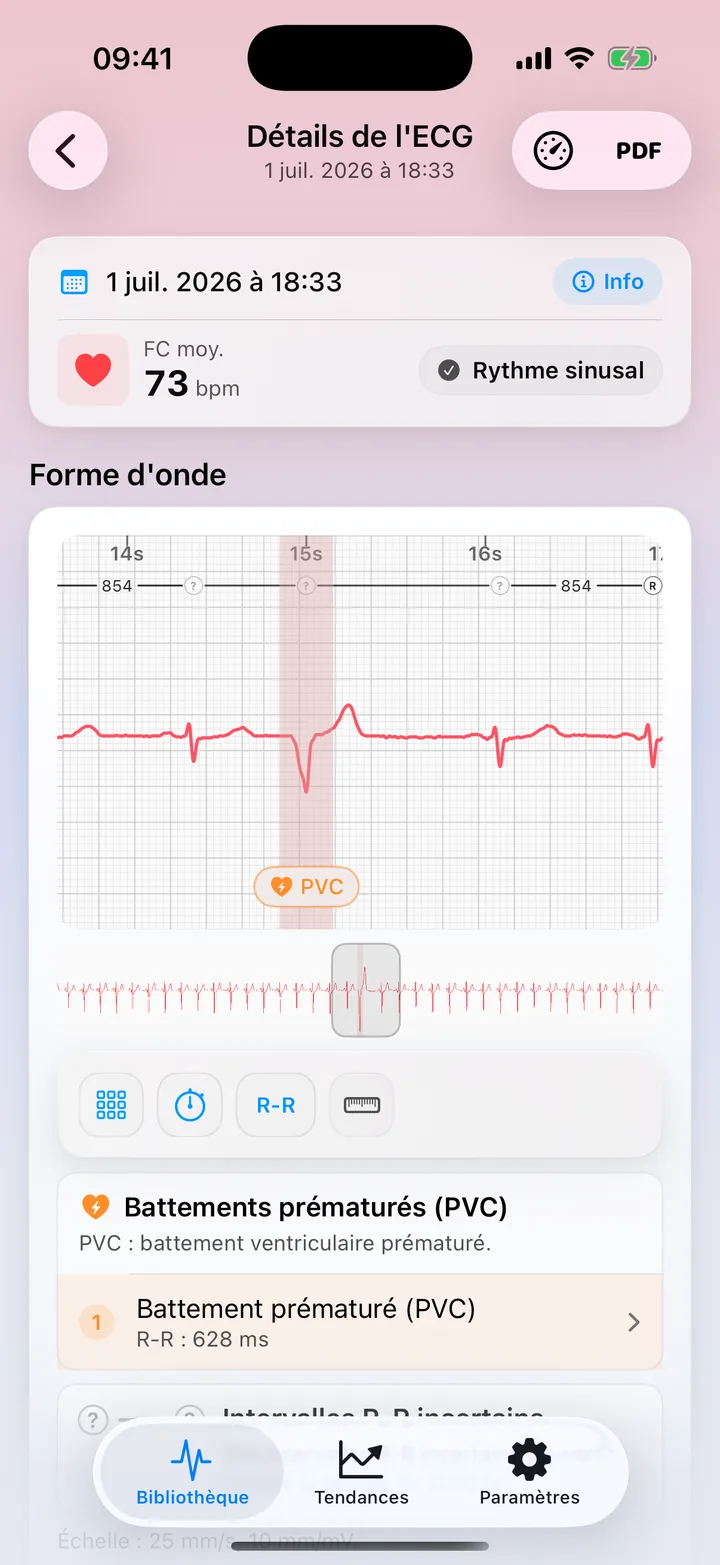Vue détaillée dans ECG Tracker+ montrant un signalement de schéma PVC possible sur le tracé
