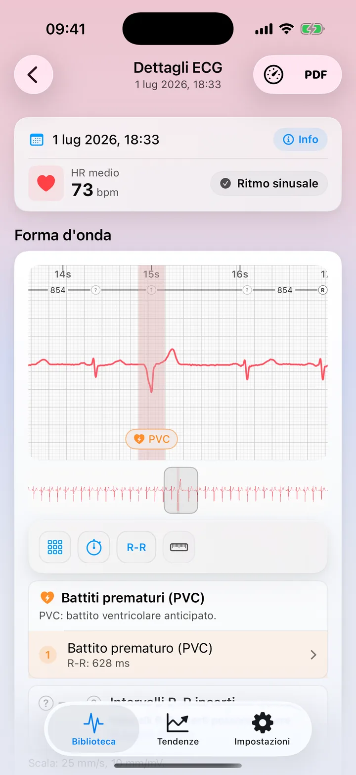 Vista dettagliata di ECG Tracker+ con una segnalazione di possibile schema PVC sul tracciato