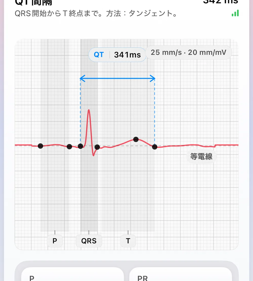 ECG Tracker+の拍動の形画面。最も安定した拍動から作られた代表的な一拍に、P・QRS・Tの基準点、等電位線、そして接線法（QRSの始まりからT波の終わりまで）で測定した341 msのQT間隔を表示