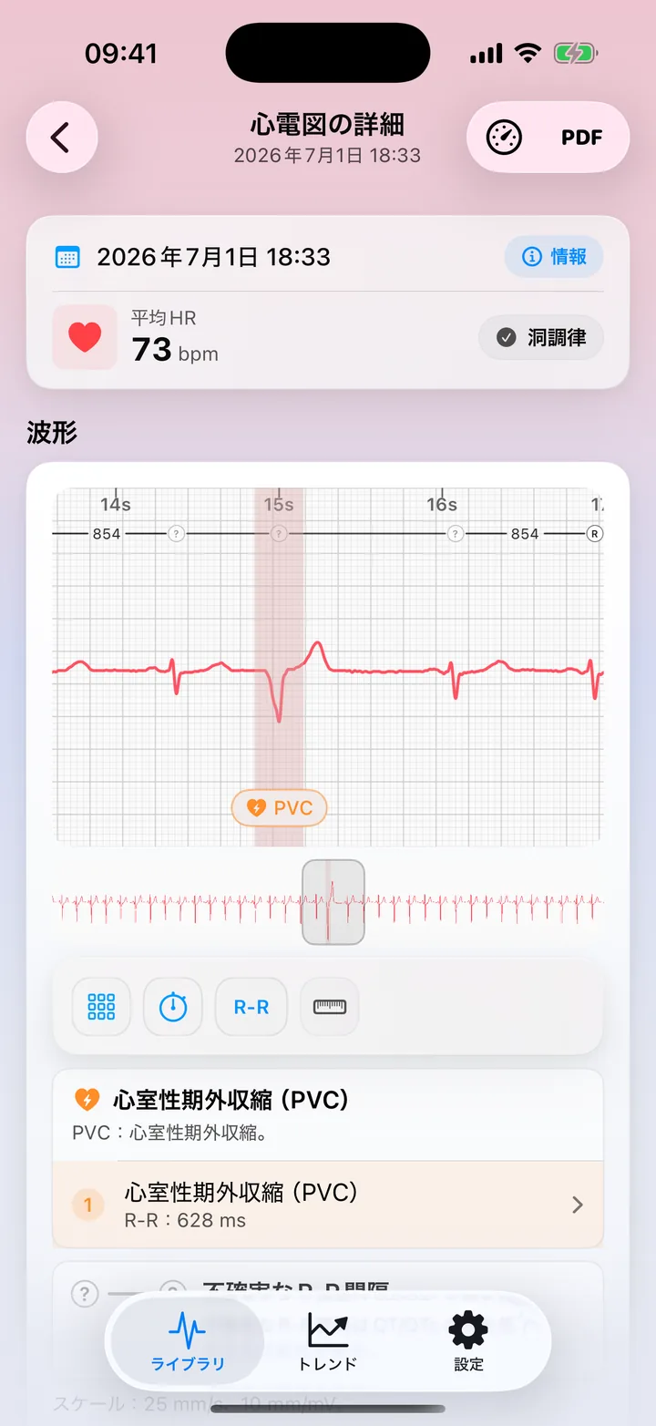 波形上にPVCの可能性を示すパターンフラグを表示したECG Tracker+の詳細画面