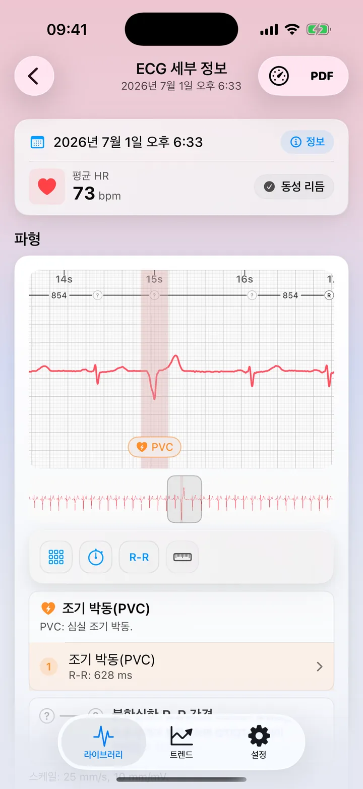 파형에 PVC 가능성 패턴 플래그를 보여 주는 ECG Tracker+ 상세 화면
