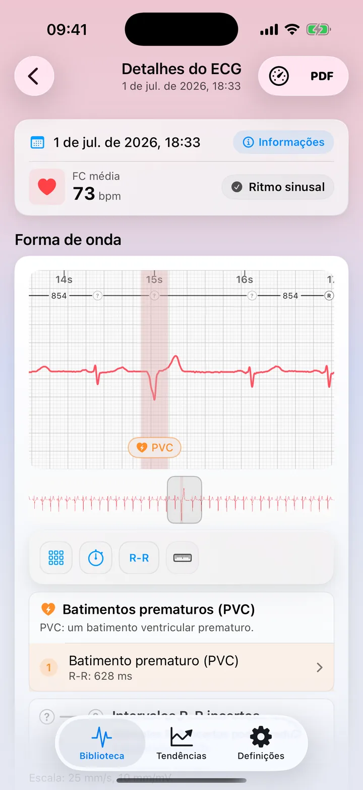 Tela detalhada do ECG Tracker+ mostrando uma sinalização de possível padrão PVC na forma de onda