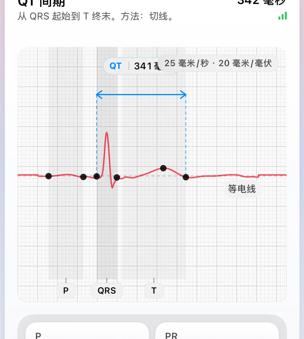 ECG Tracker+ 心搏形态界面：由最稳定的心搏合成的一次代表性心搏，标有 P、QRS、T 基准标记与等电位线，以及用切线法（从 QRS 起点到 T 波终点）测得的 341 ms QT 间期。