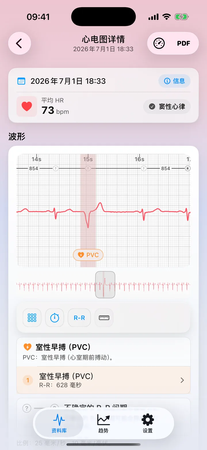 ECG Tracker+ 详情界面，在波形上显示可能的 PVC 模式标记